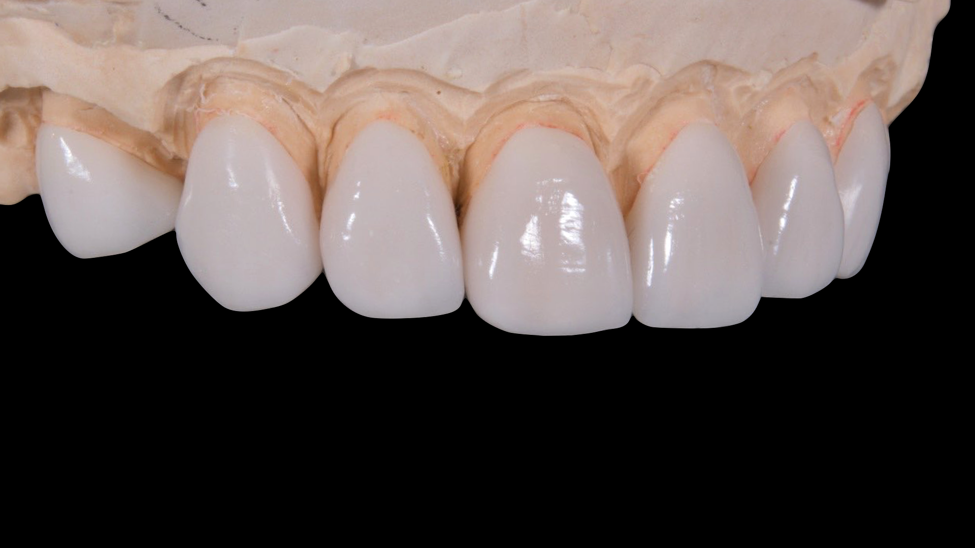 What is Tooth Contouring in Mint Hill, Near Charlotte?